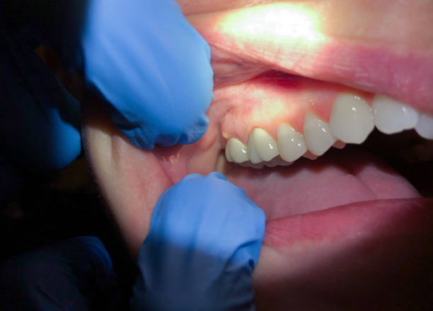 Best Emergency Denture Repair in Kingston, PA